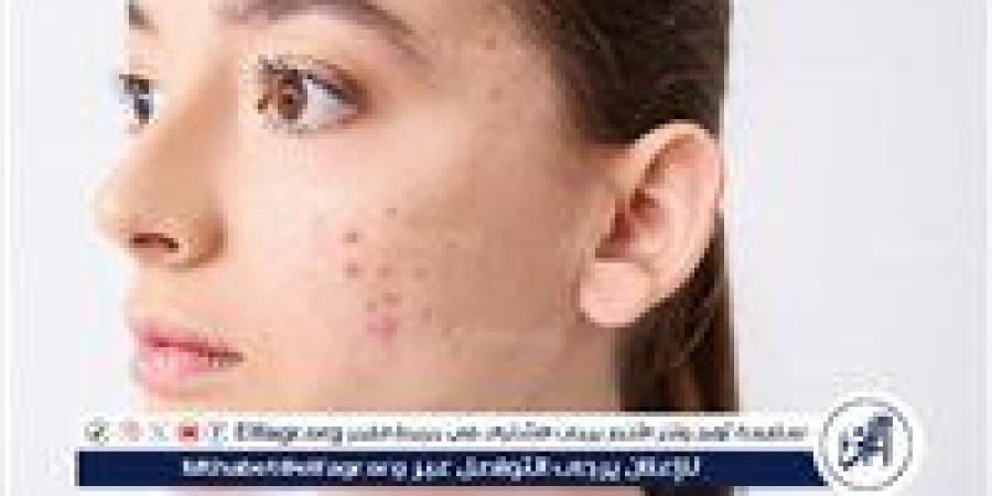 كيفية
      التخلص
      من
      آثار
      الحبوب
      واستعادة
      صفاء
      البشرة