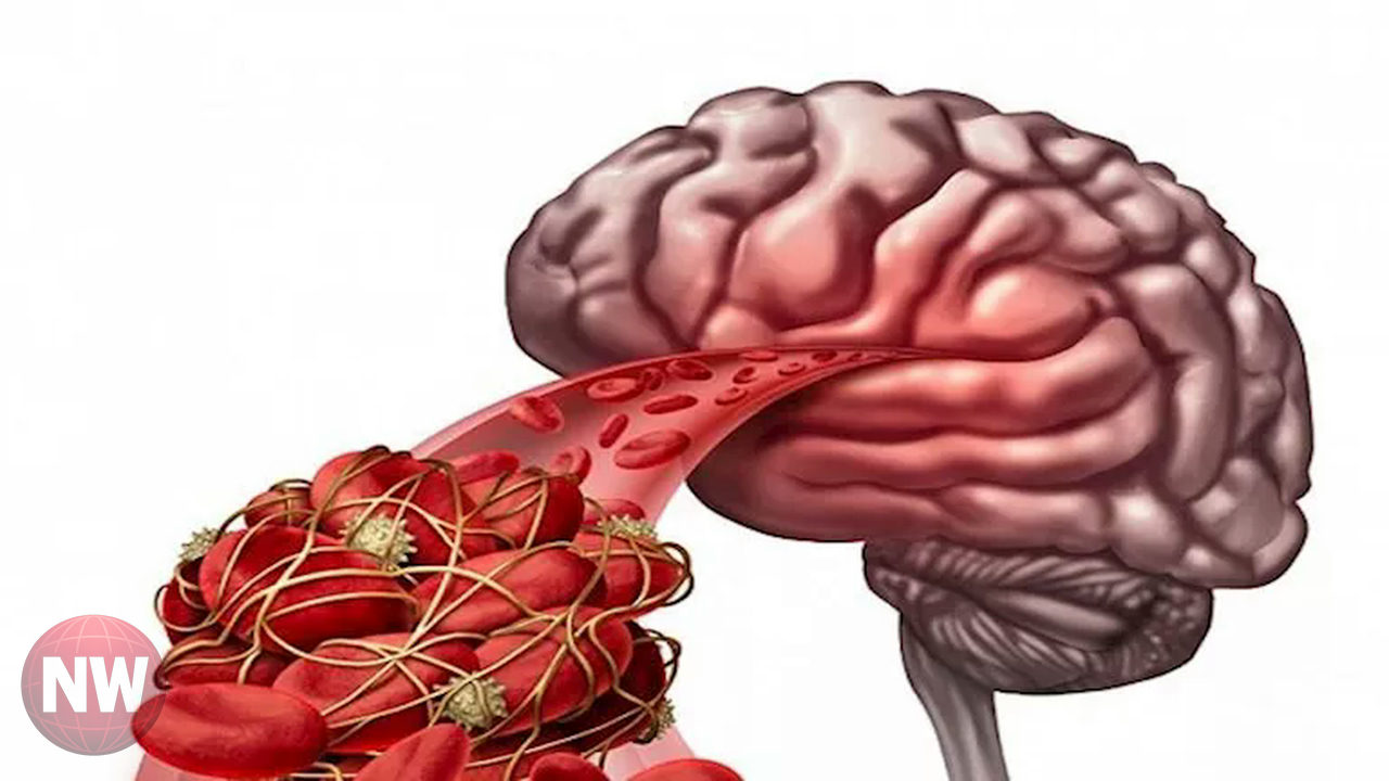 مخاطر الجلطات الدماغية في رمضان: أعراض وعوامل خطر وطرق علاج