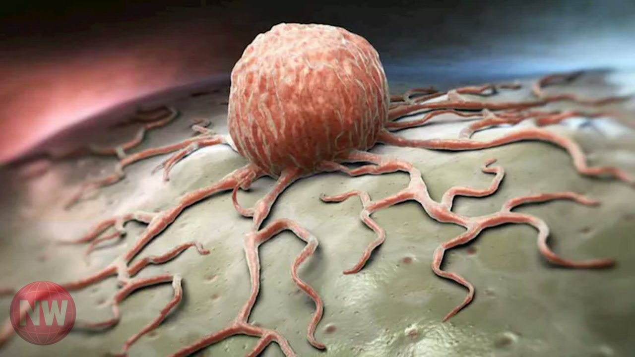 4 علامات مبكرة لسرطان المبيض.. أبرزها الانتفاخ وصعوبة تناول الطعام