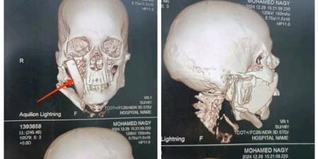 جامعة
      أسيوط
      تنجح
      في
      إجراء
      عملية
  ...